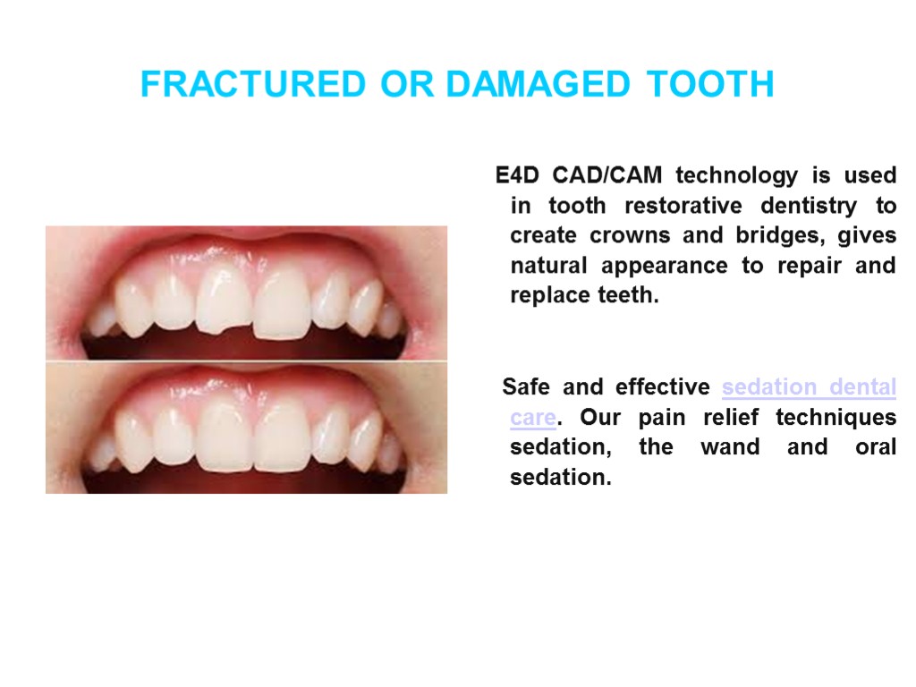 FRACTURED OR DAMAGED TOOTH E4D CAD/CAM technology is used in tooth restorative dentistry to